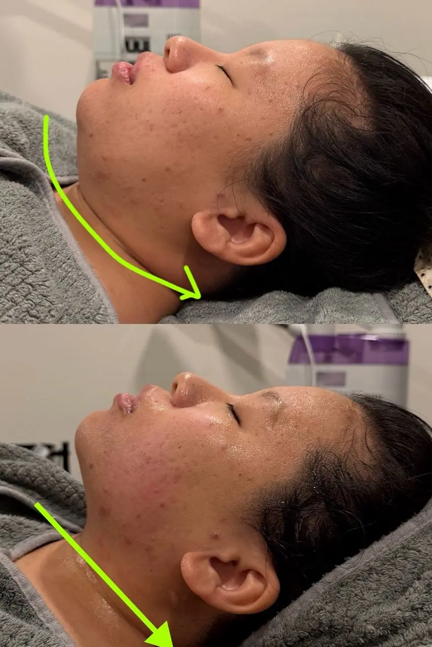 Titanium Ultrasound Lifting — Before & After 2 · The Valley, Kuala Lumpur