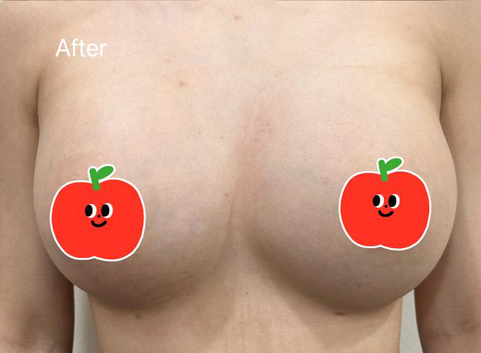 Breast Implant — Before & After · The Valley, Kuala Lumpur