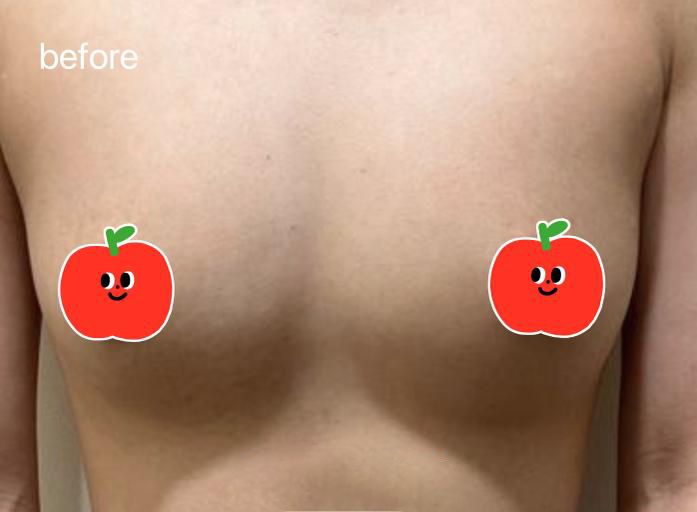 Breast Implant — Before & After · The Valley, Kuala Lumpur