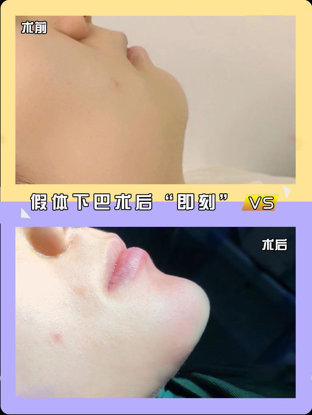 Chin Implant — Before & After · The Valley, Kuala Lumpur