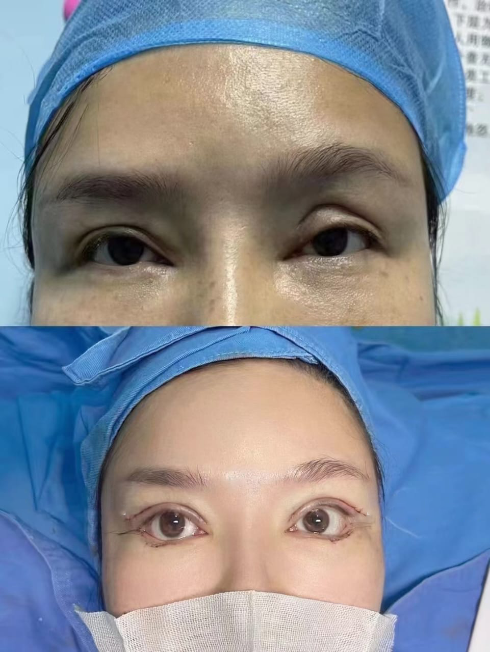 Eye Treatment — Before & After · The Valley, Kuala Lumpur