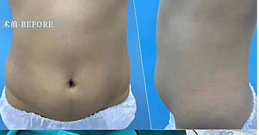 Liposuction before