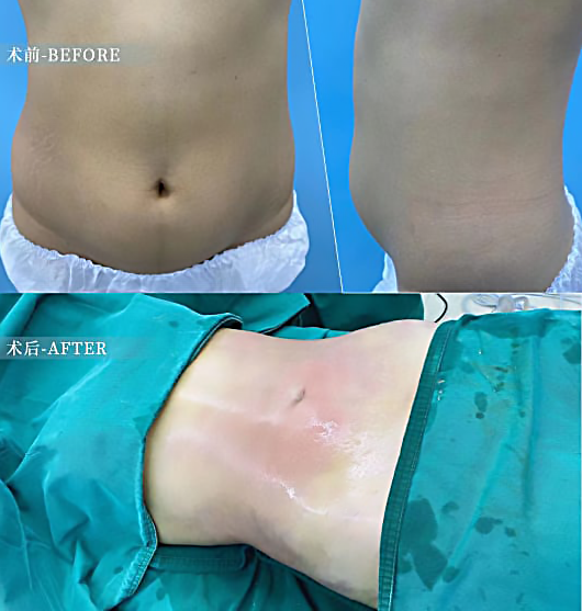 Liposuction — Before & After · The Valley, Kuala Lumpur