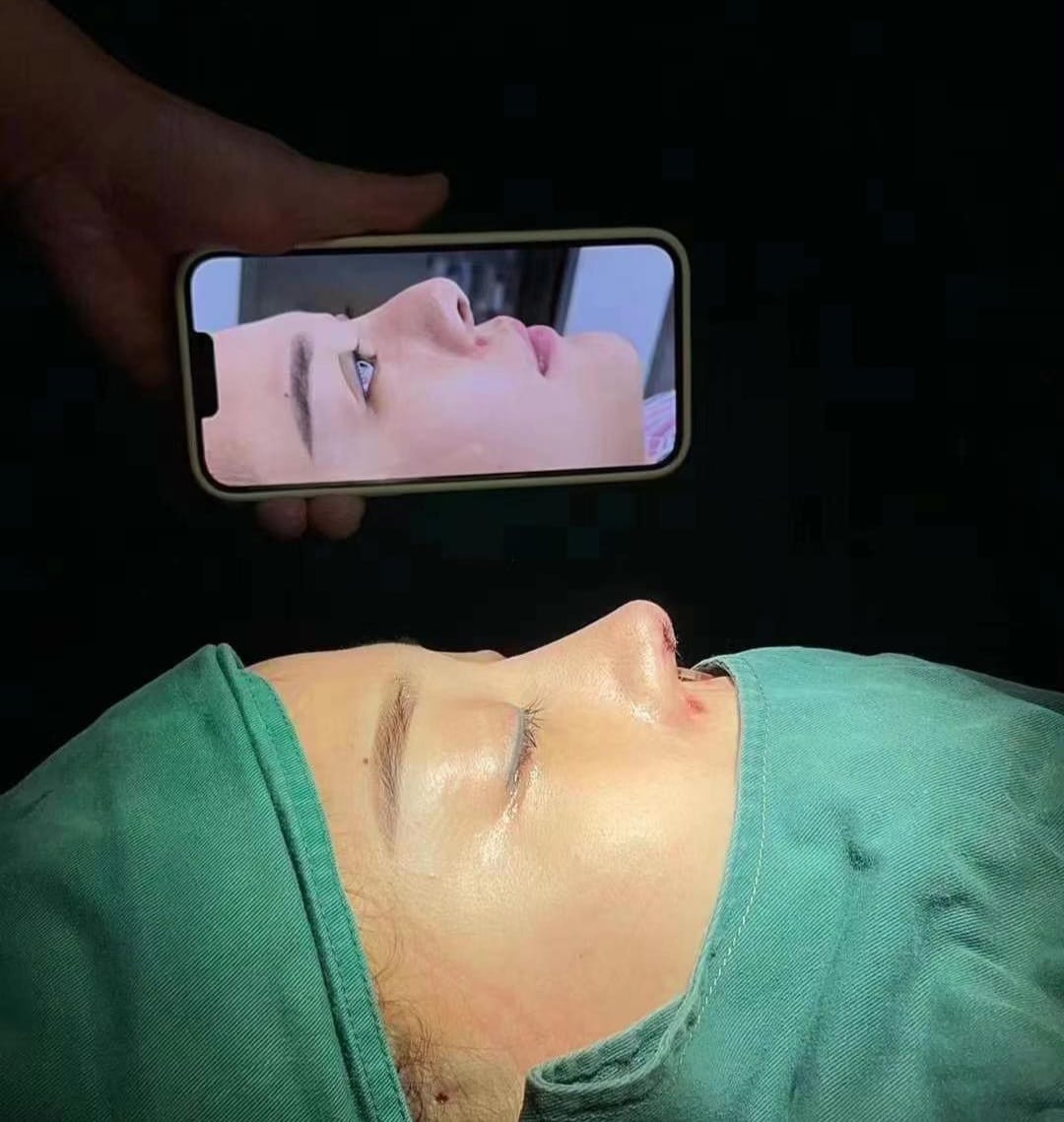 Rhinoplasty — Before & After · The Valley, Kuala Lumpur
